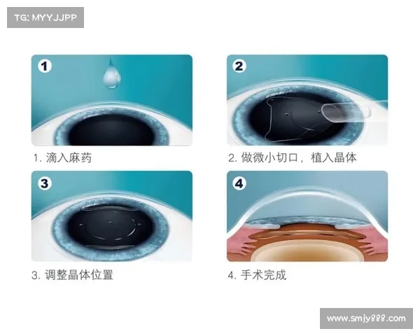 ICL和T-ICL晶体植入有什么区别?你想知道的就看这一篇 ICL和T-ICL晶体植入有什么区别?你想知道的就看这一篇